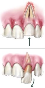 dental trauma